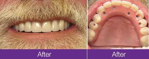 Implant Before &amp; After Cases Oral Arts Dental