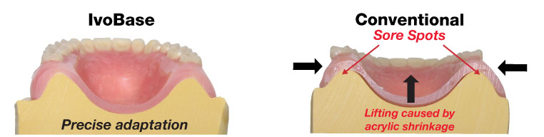 Ivoclar IvoBase® Injection System | Oral Arts Dental Laboratories